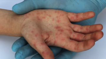 Jalisco reports no active cases of Mpox in the last week